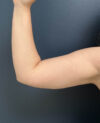 Liposuction case #13953