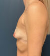 Breast Augmentation case #13856