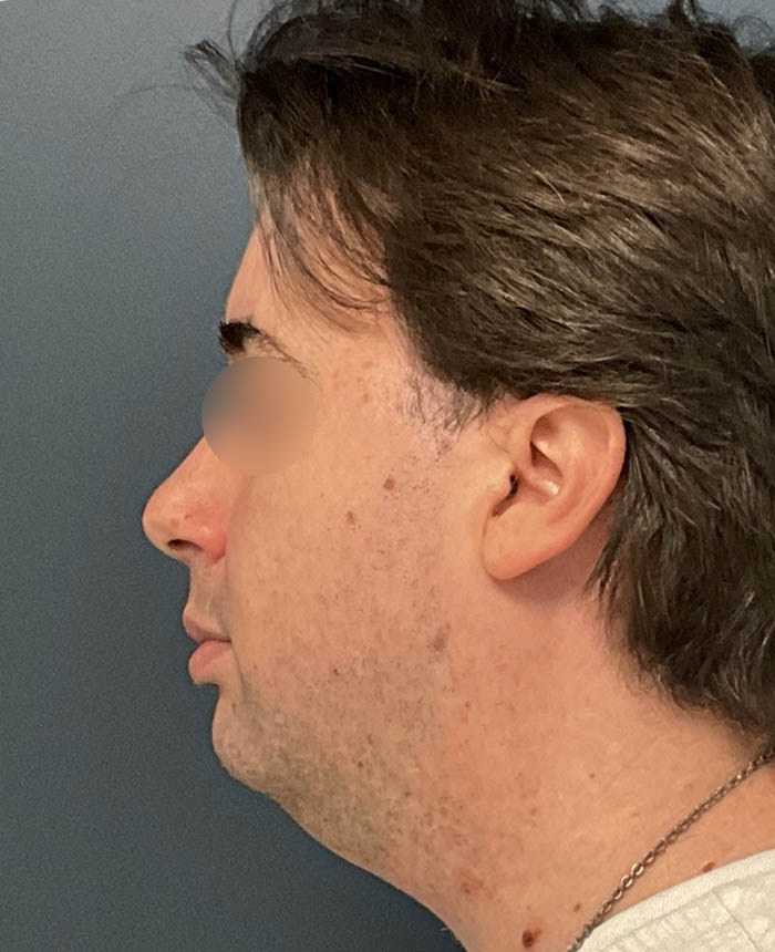 Facial Feminization Surgery case #13939
