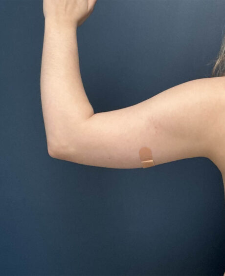 Liposuction case #13953