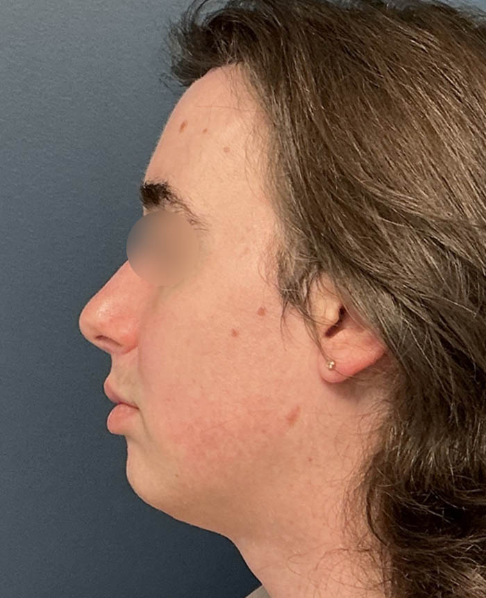 Facial Feminization Surgery case #13939