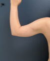 Liposuction case #13953