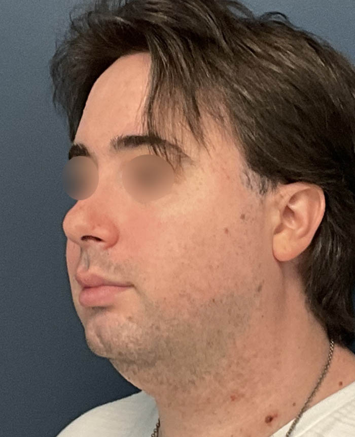 Facial Feminization Surgery case #13939