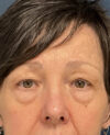 Eyelid Surgery case #13901