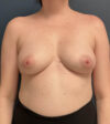 Breast Augmentation case #13861
