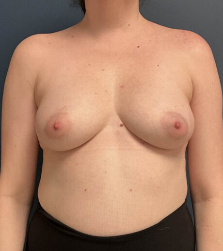 Breast Augmentation case #13861