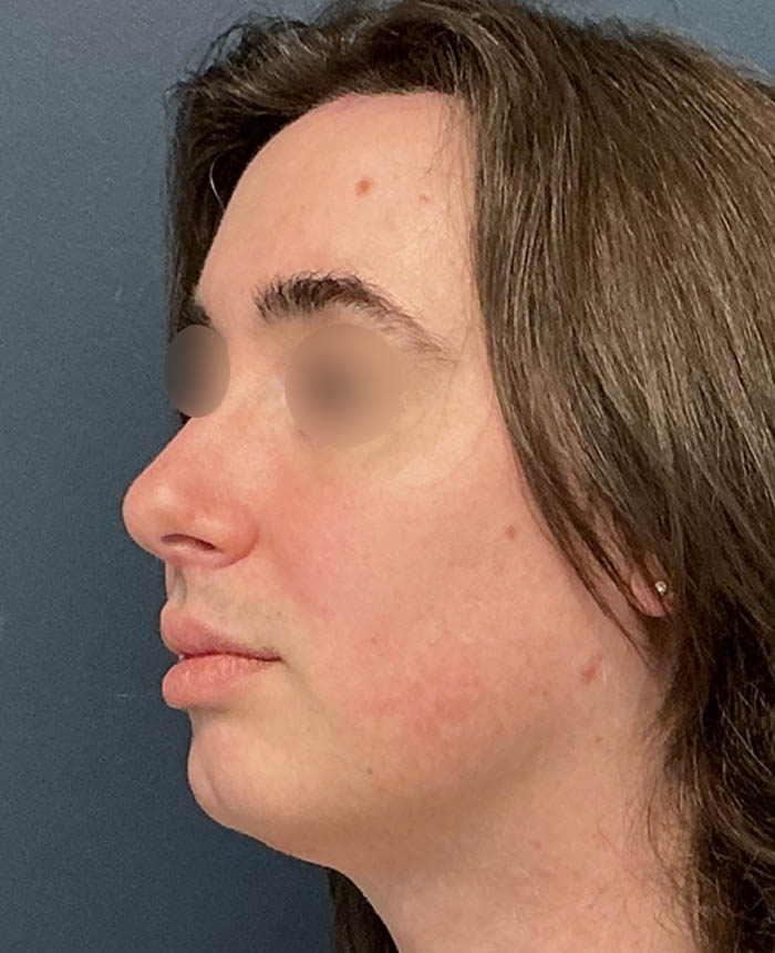 Facial Feminization Surgery case #13939