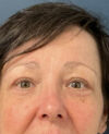 Eyelid Surgery case #13901