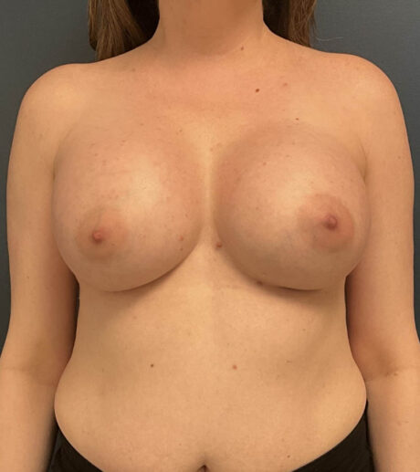 Breast Augmentation case #13861