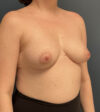 Breast Augmentation case #13861