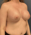 Breast Augmentation case #13861