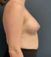 Breast Augmentation case #13861