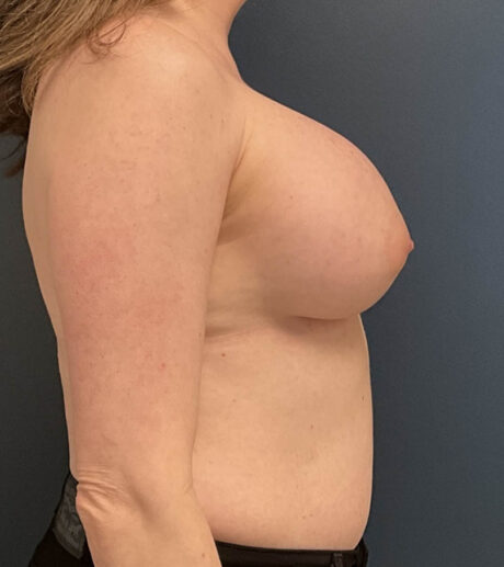 Breast Augmentation case #13861
