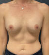 Breast Revision case #13882