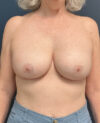 Breast Implant Exchange case #13958