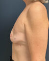 Breast Implant Exchange case #13958