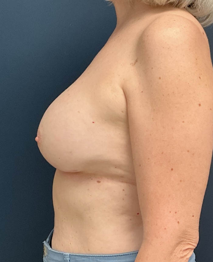 Breast Implant Exchange case #13958