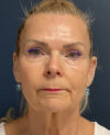 Facelift case #13925