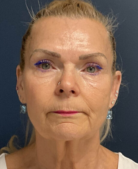 Facelift case #13925