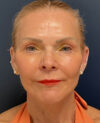Facelift case #13925