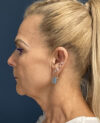 Facelift case #13925
