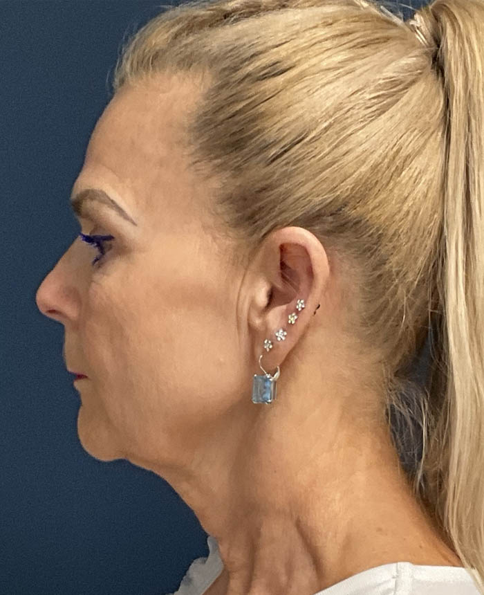 Facelift case #13925