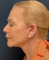 Facelift case #13925