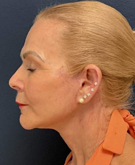 Facelift case #13925