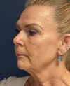 Facelift case #13925