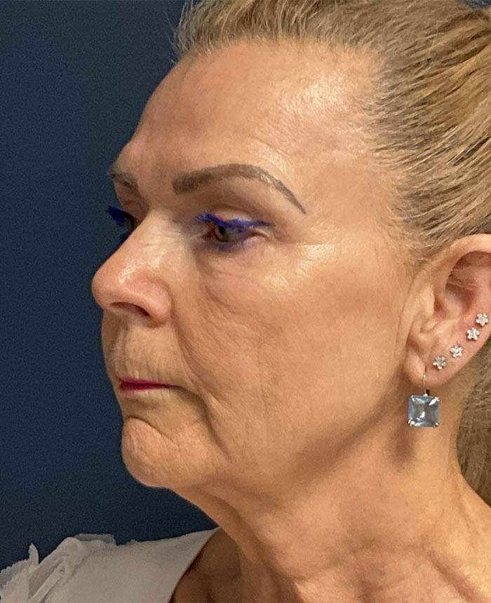 Facelift case #13925