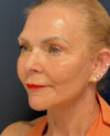 Facelift case #13925