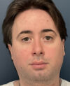 Facial Feminization Surgery case #13939