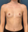 Breast Augmentation case #13946