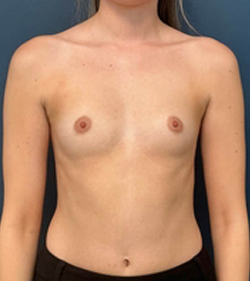 Breast Augmentation case #13946