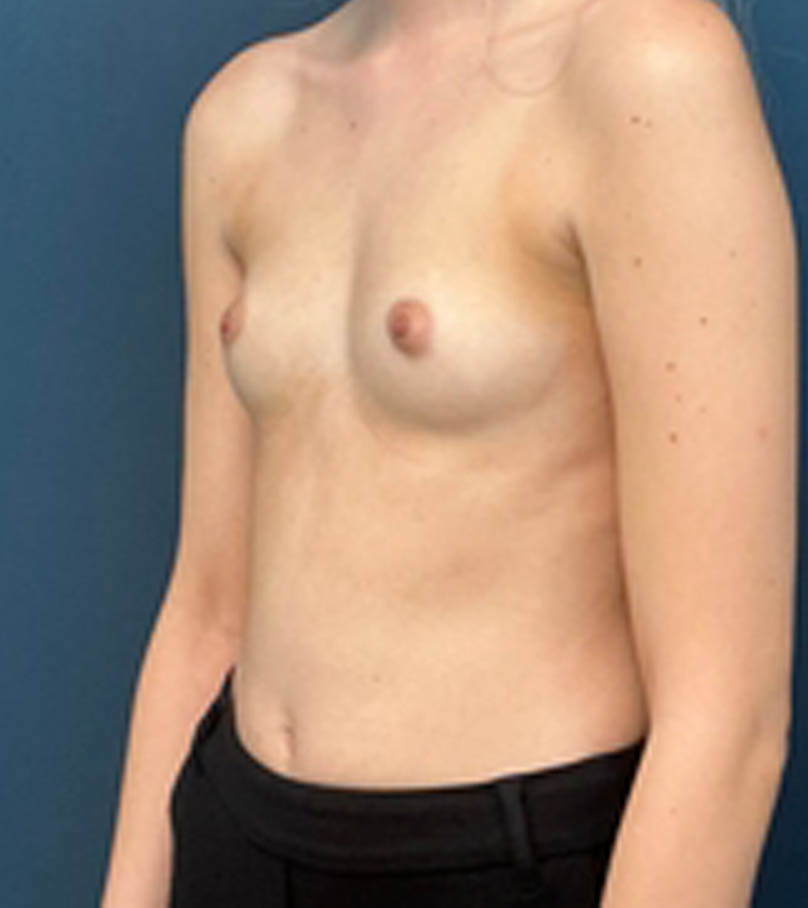 Breast Augmentation case #13946