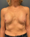 Breast Implant Exchange case #13894