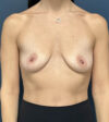 Breast Augmentation case #13932