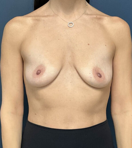 Breast Augmentation case #13932