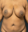 Breast Lift case #13971