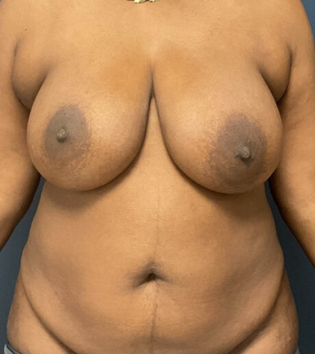Breast Lift case #13971