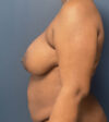 Breast Lift case #13971