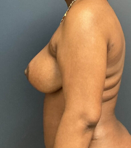 Breast Lift case #13971