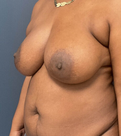 Breast Lift case #13971