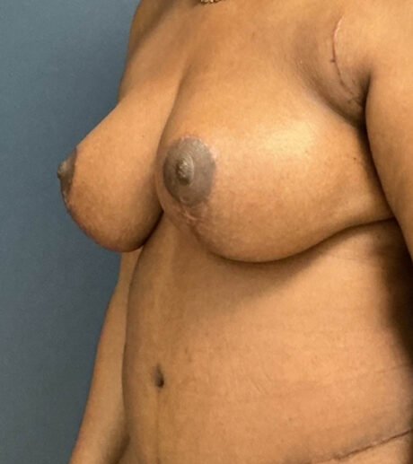 Breast Lift case #13971