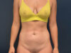 Tummy Tuck case #13918