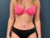 Tummy Tuck case #13918