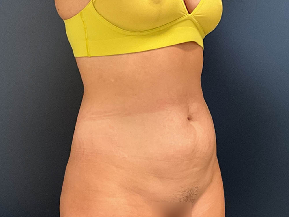 Tummy Tuck case #13918