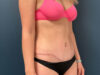 Tummy Tuck case #13918