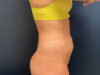 Tummy Tuck case #13918