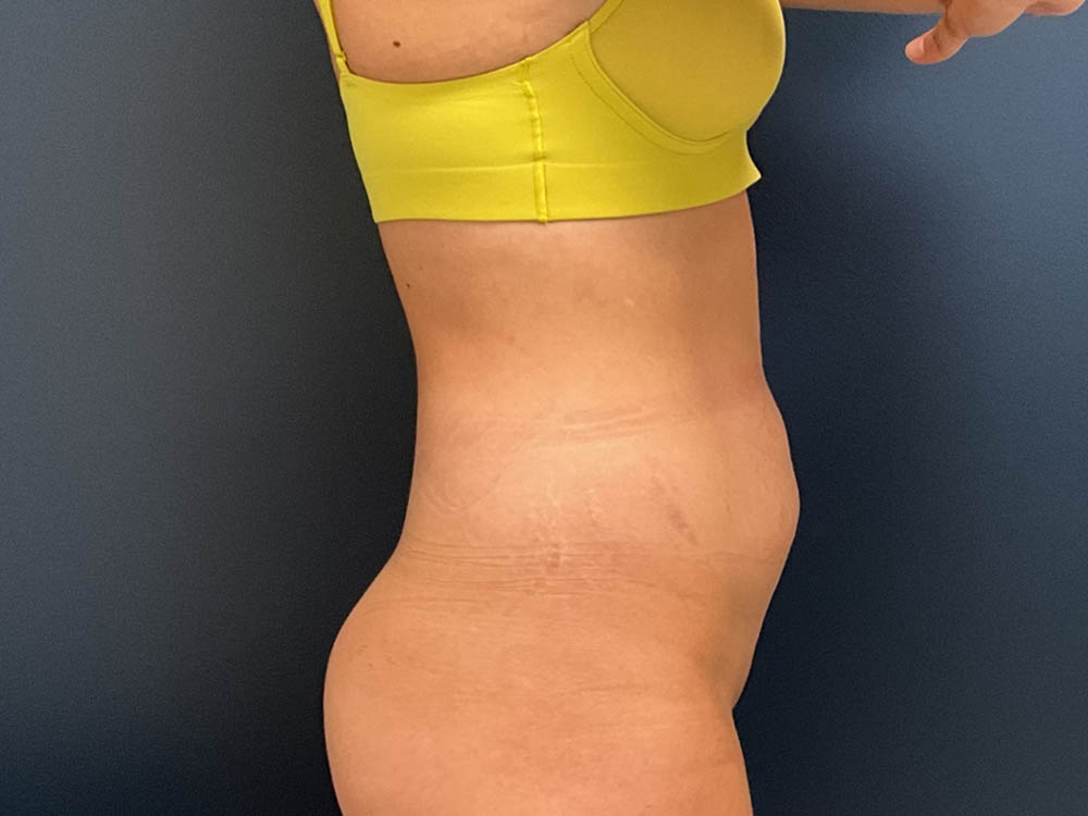 Tummy Tuck case #13918